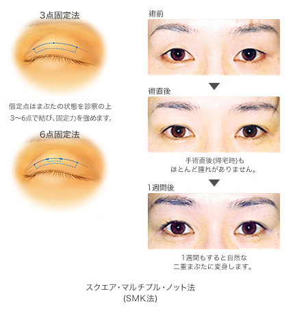 二重埋没 Smk法 の美容整形 東京都渋谷区恵比寿リッツ美容外科