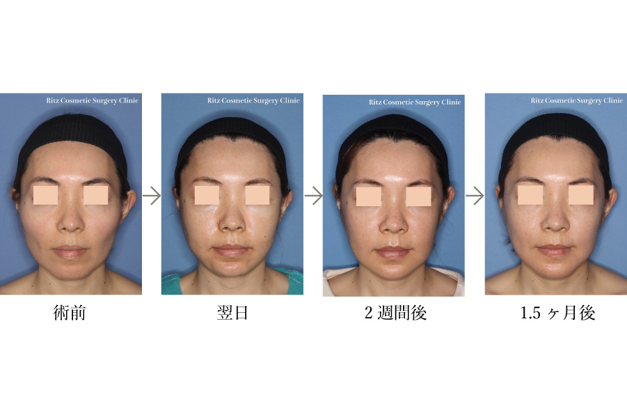 症例写真：下顎形成術（下顎角切除＋外板切除）＋頬骨縮小術＋オトガイ ホームベース型骨切り術
