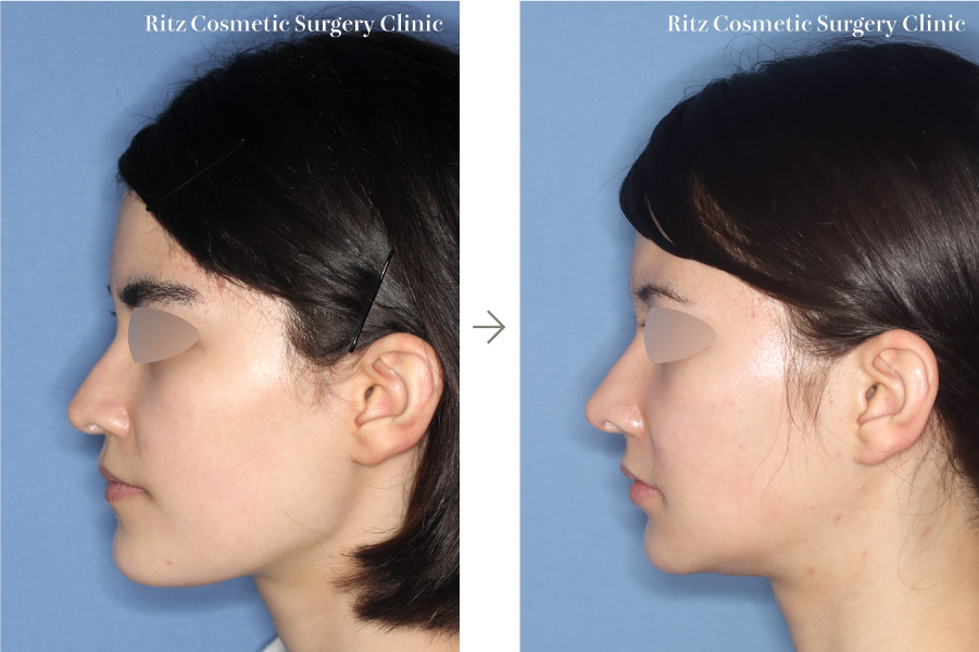 症例写真：ルフォーⅠ型骨切り術(LeFort-1)＋下顎枝矢状分割術(SSRO)＋下顎Vライン形成術（下顎角切除）＋頬骨縮小術