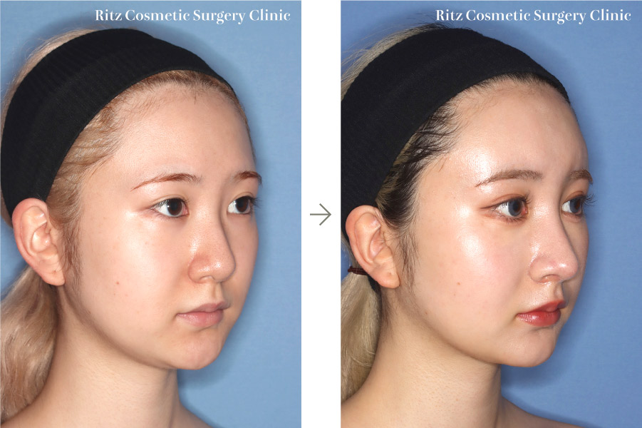 症例写真：鼻中隔延長術＋鼻尖縮小術＋シリコンプロテーゼ(左側面)