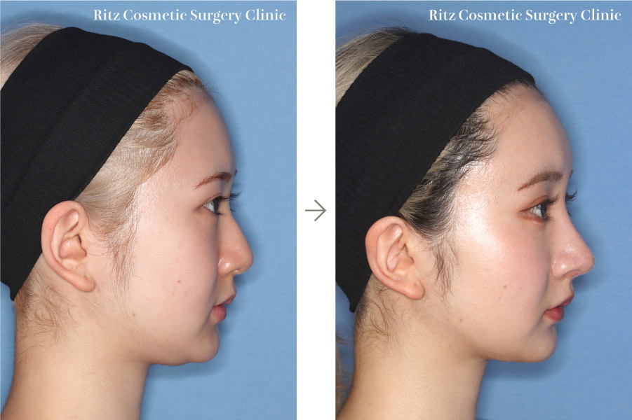 症例写真：鼻中隔延長術＋鼻尖縮小術＋シリコンプロテーゼ(左斜め)