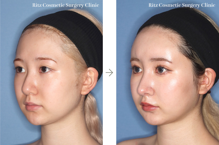症例写真：鼻中隔延長術＋鼻尖縮小術＋シリコンプロテーゼ(右斜め)