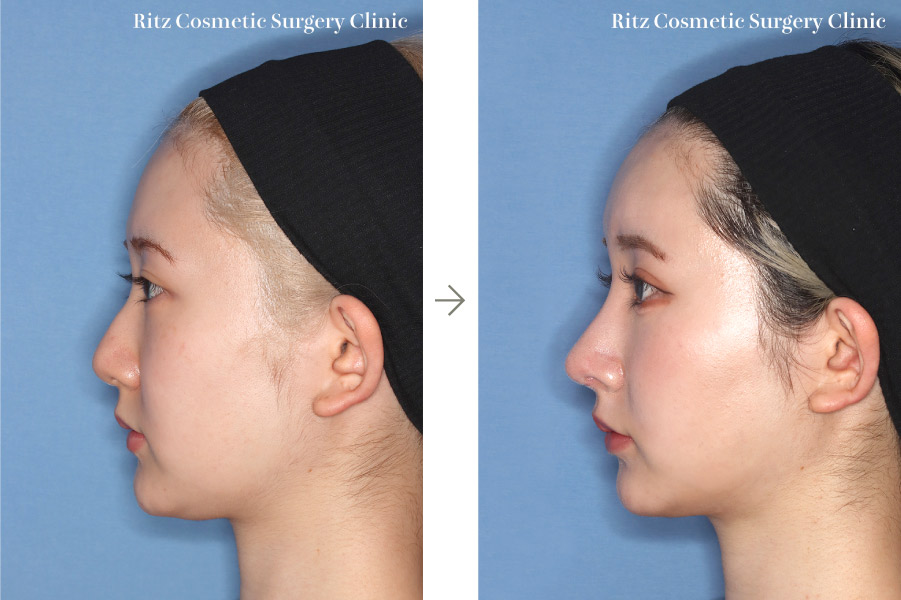 症例写真：鼻中隔延長術＋鼻尖縮小術＋シリコンプロテーゼ(右側面)